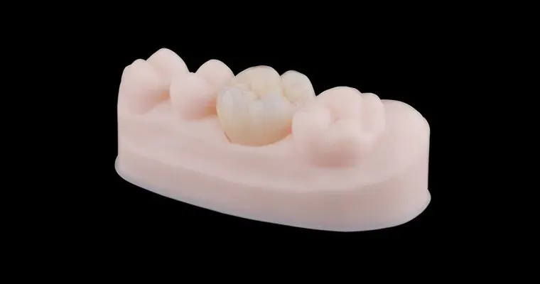 치아 모델로 제시된 치과 임플란트 또는 보철물의 의료 기구 사진입니다.